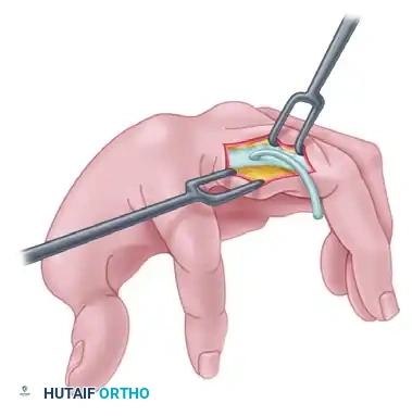 TRANSFER OF THE FLEXOR DIGITORUM SUBLIMIS OF THE RING FINGER Surgical Diagram
