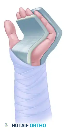 TRANSFER OF THE FLEXOR DIGITORUM SUBLIMIS OF THE RING FINGER Surgical Diagram