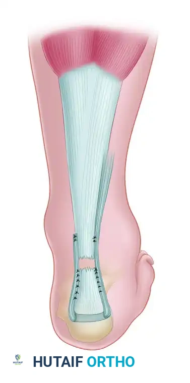 TRANSFER OF THE PERONEUS BREVIS TENDON FOR NEGLECTED RUPTURES OF THE ACHILLES TENDON Surgical Diagram