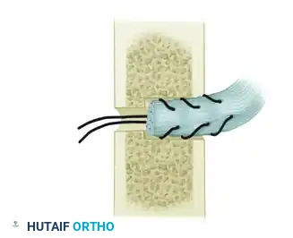 TRANSFER OF THE PRONATOR TERES Surgical Diagram