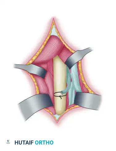 TRANSFER OF THE PRONATOR TERES Surgical Diagram