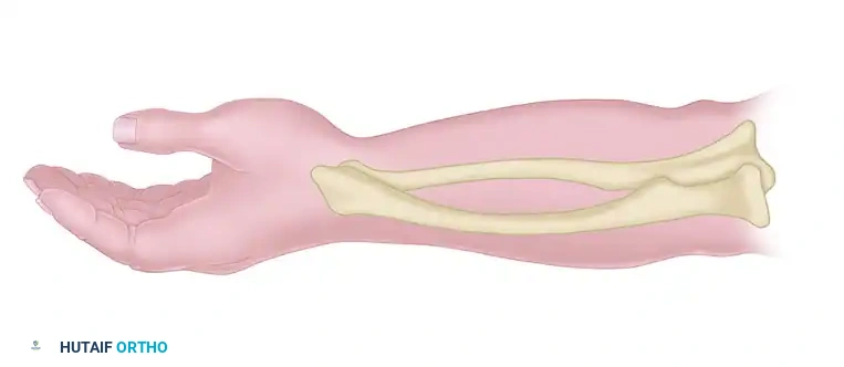 TRANSFER OF THE PRONATOR TERES Surgical Diagram