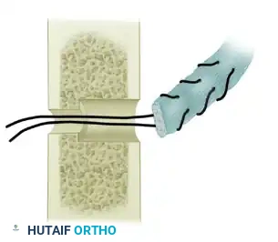 TRANSFER OF THE PRONATOR TERES Surgical Diagram