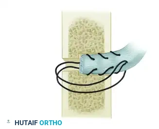 TRANSFER OF THE PRONATOR TERES Surgical Diagram