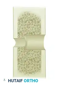 TRANSFER OF THE PRONATOR TERES Surgical Diagram