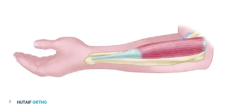 TRANSFER OF THE PRONATOR TERES Surgical Diagram