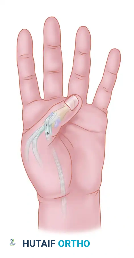 Sublimis Tendon Transfer for Thumb Opposition (Riordan)