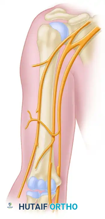 TRANSFER OF THE ULNAR NERVE FASCICLES TO NERVE OF THE BICEPS MUSCLE Surgical Diagram
