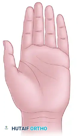 Operative Management of Upper Extremity Nerve Entrapments: Ulnar Transposition and Median Nerve Decompression