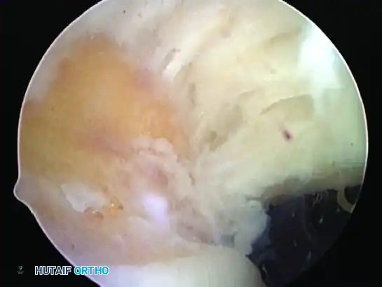 TRANSTENDINOUS REPAIR OF A PARTIAL ARTICULAR-SIDE SUPRASPINATUS TENDON AVULSION LESION Surgical Diagram