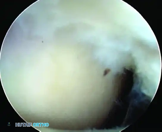 Transtendinous Repair of Partial Articular-Side Supraspinatus Tendon Avulsions