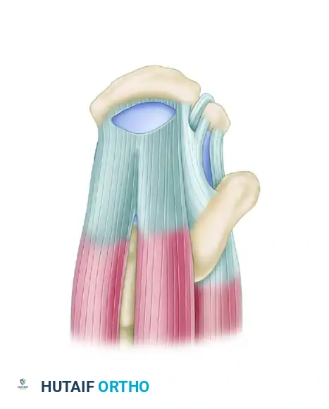 TRANSTENDINOUS REPAIR OF A PARTIAL ARTICULAR-SIDE SUPRASPINATUS TENDON AVULSION LESION Surgical Diagram
