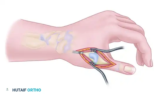 TRAPEZIOMETACARPAL ARTHRODESIS Surgical Diagram