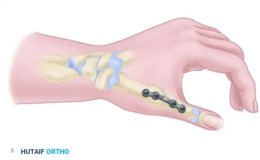Mastering Trapeziometacarpal Arthrodesis and Rheumatoid Wrist Synovectomy