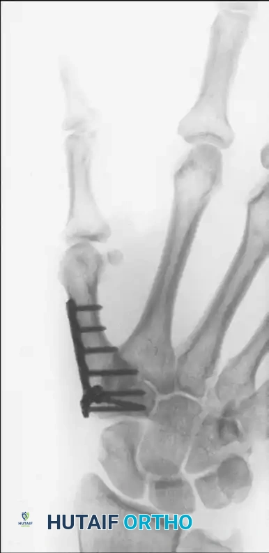TRAPEZIOMETACARPAL ARTHRODESIS Surgical Diagram