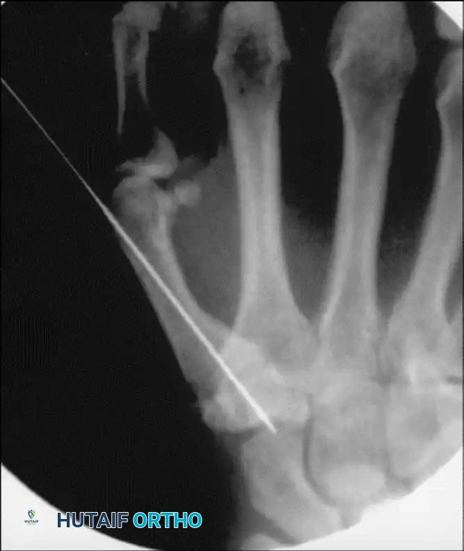 TRAPEZIOMETACARPAL ARTHRODESIS Surgical Diagram