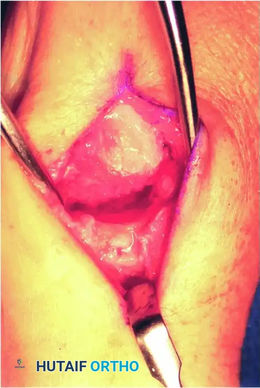 TRAPEZIOMETACARPAL ARTHRODESIS Surgical Diagram