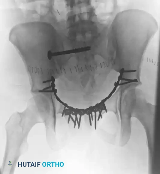 TREATMENT Surgical Diagram