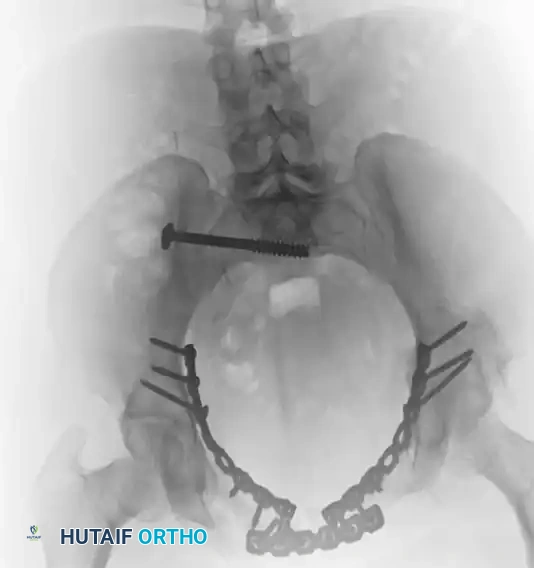 TREATMENT Surgical Diagram