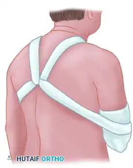 TREATMENT Surgical Diagram