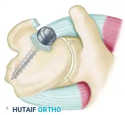 TREATMENT Surgical Diagram