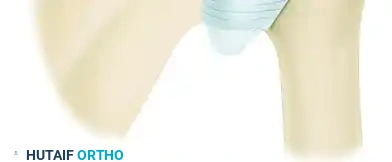 TREATMENT Surgical Diagram