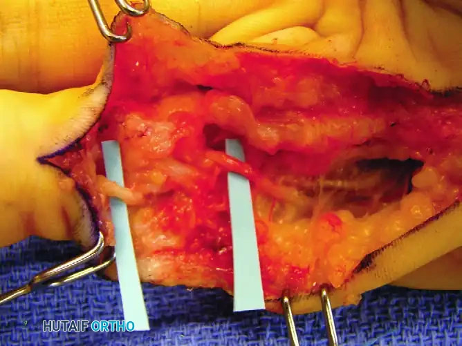 Nodule and cord exposed