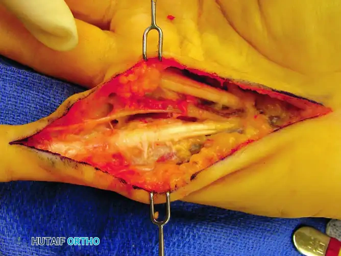 Return of ulnar digital nerve