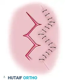 Additional Incision Diagram