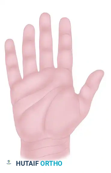 Transverse incisions