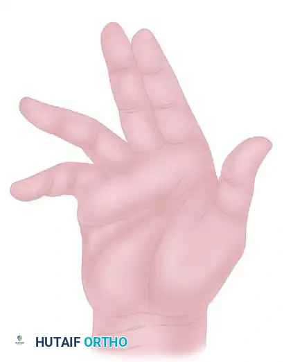 V-Y plasty method completion