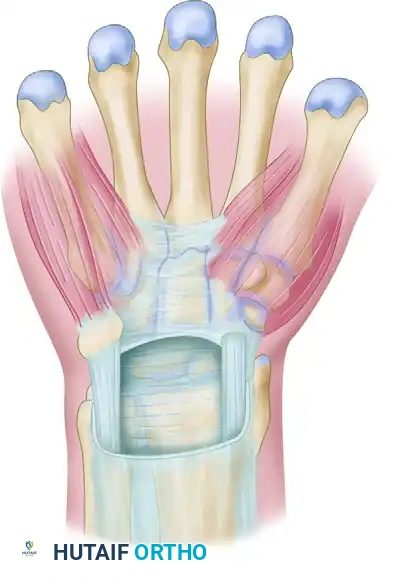 Carpal Tunnel Syndrome: Comprehensive Treatment and Surgical Release