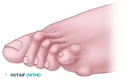 FIGURE 84-4 A, Small proliferation of bone at end of fifth metatarsal (right foot). Joint spaces 1 year after surgery are maintained because of adequate bone resection.