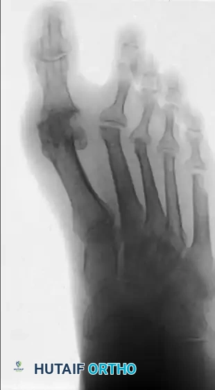 TREATMENT Surgical Diagram
