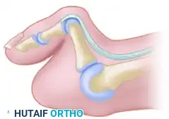 TREATMENT Surgical Diagram