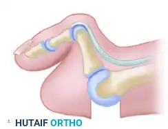 TREATMENT Surgical Diagram