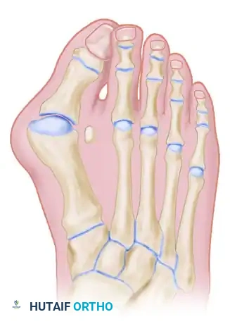 TREATMENT Surgical Diagram
