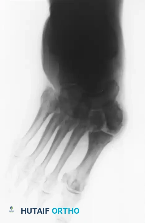 الدليل الشامل لعلاج قدم شاركو والخيارات الجراحية وغير الجراحية
