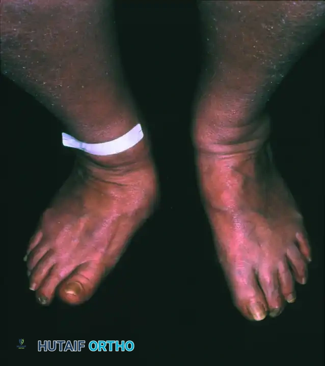 توضيح لخلع المفاصل وتفتت العظام في قدم شاركو