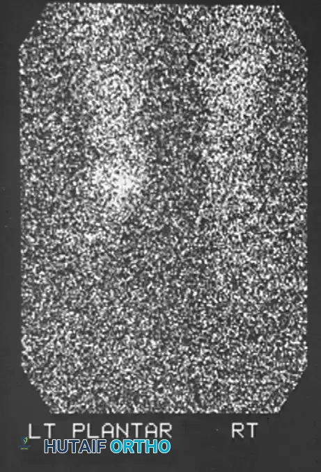 صورة تظهر تشوه القدم والتغيرات العظمية الشديدة