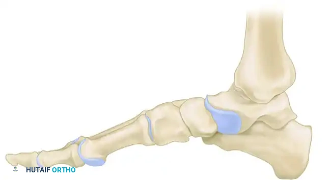 مسح ذري للعظام يوضح نشاط المرض والاشتباه في التهاب العظم والنقي