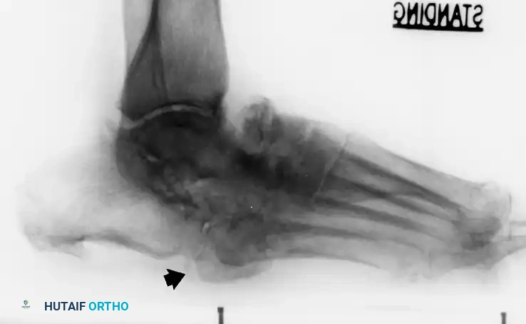 أشعة سينية تظهر البروز العظمي المسبب للقرحة