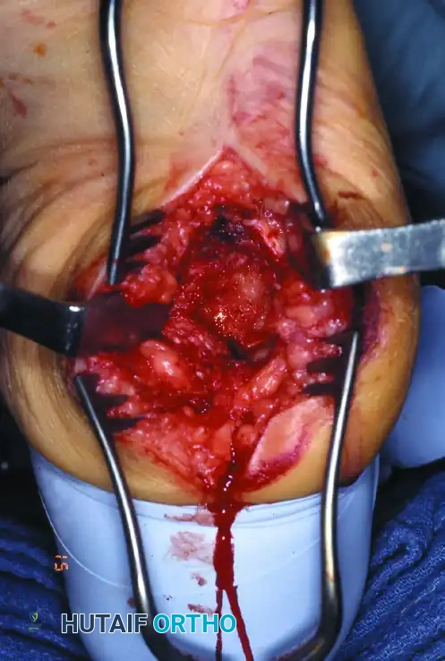 استئصال العظم البارز للتخفيف من الضغط