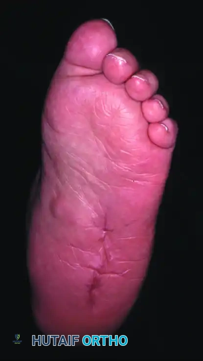 إغلاق الجرح الجراحي بغرز قوية لتجنب الفراغات