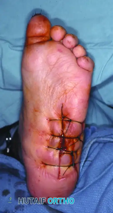 النتيجة بعد واحد وعشرين شهراً من إزالة العظم واستخدام الأحذية الواقية