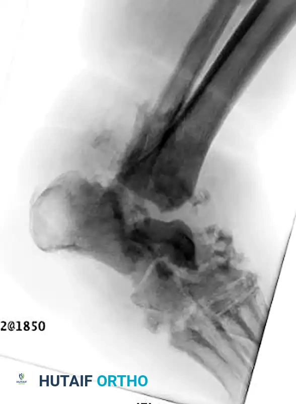 صورة أخرى توضح خطورة المضاعفات التي قد تؤدي للبتر