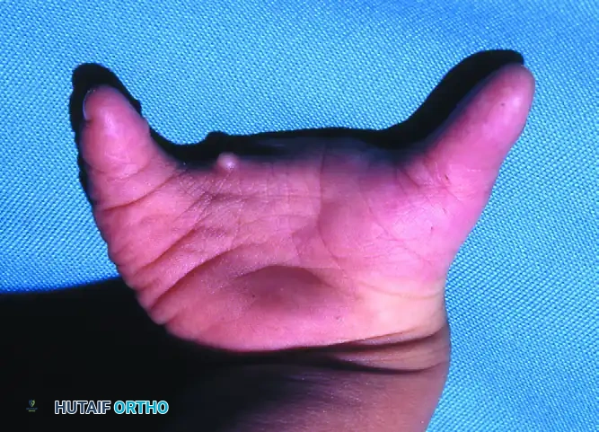 FIGURE 79-22 Typical pattern of central deficiency with central V -shaped cleft.
