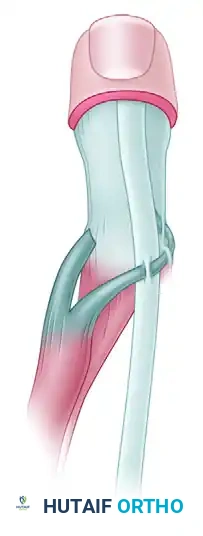 TRICEPS TRANSFER TO RESTORE ELBOW FLEXION Surgical Diagram