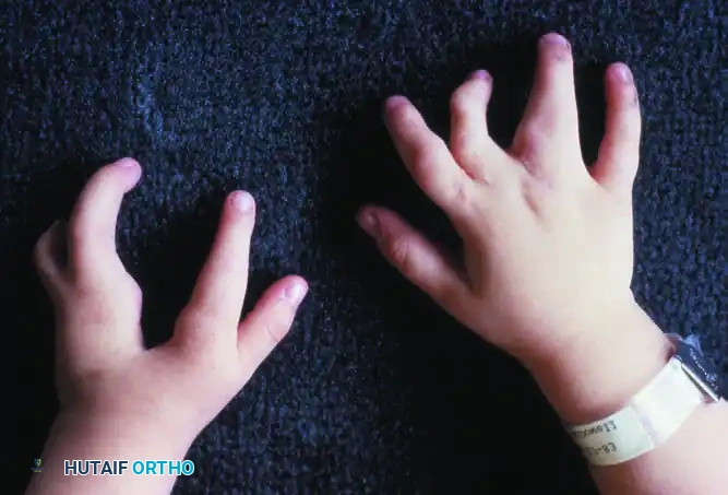 FIGURE 79-24 Flatt’s classification of central deficiencies.