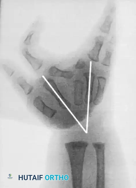 Radiographic measurement technique for metacarpal and phalangeal divergence angles
